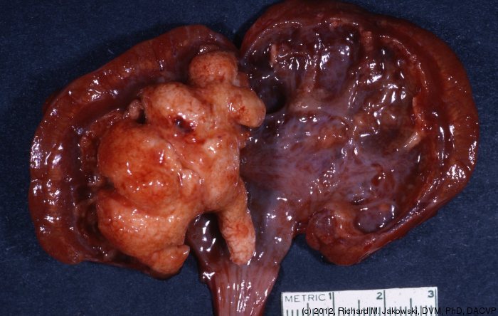 Laparoscopic Nephrolithotomy